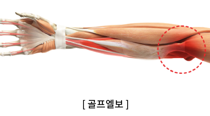 골프엘보
